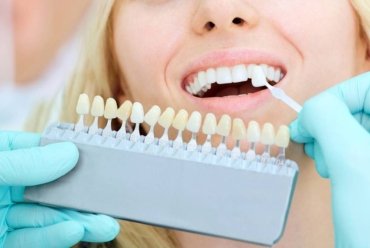 Restauraciones estéticas dentales